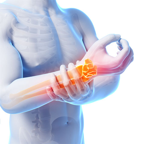 Illustration of hand pain